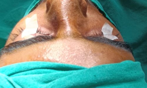 RHINOPLASTY CASE PREOP (1)