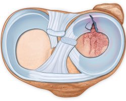 axial-view-of-fractured-tibia-and-torn-meniscus-667599137-5b91a26246e0fb00502b8270