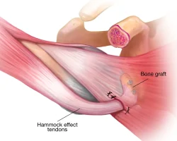 latarjet-stabilizes-shoulder-two-ways